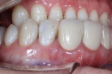 Реставрация передних зубов композитом (эстетическая пломба) - — 1