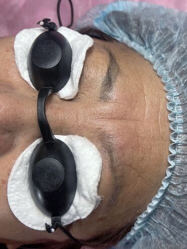 художественная реставрация зубов композитными материалами: Удаление старого перманента бровей — лазером и маслом. - — 3