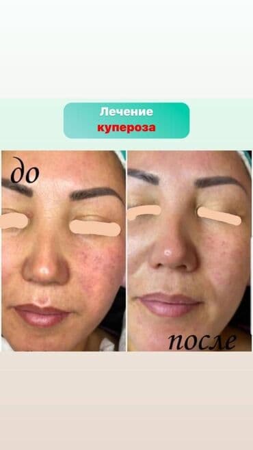 хиджама кровопускание: Косметология, Чистка кожи, Биоревитализация, Пилинг, Сертифицированный косметолог, Гипоаллергенные материалы, Консультация — 6