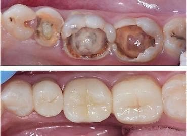 клиника дентомакс бишкек: Лечение кариеса 
Фотопломба
Чистка
Удаление 
Протезирование — 2