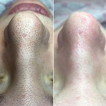 косметолог кант: Косметология, Чистка кожи, Консультация, Требуются модели, Сертифицированный косметолог — 1