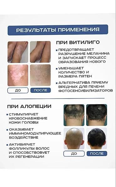 Медициналык лампалар: Уф лампа витилиго 311 нм – передовое решение для эффективной домашней — 5