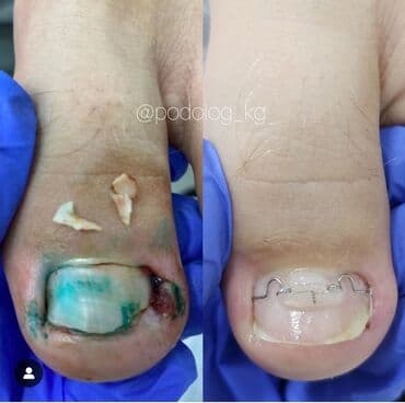 маникюр педикюр с выездом на дом: Коррекция вросших ногтей, Услуги подолога, Маникюр, Педикюр, С выездом на дом, Консультация, Одноразовые расходные материалы — 2