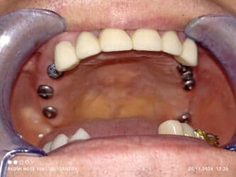 хиджама кровопускание: Клиника | Стоматолог | Протезирование — 13