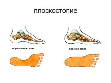 детская лечебная ортопедическая обувь: Стельки ортопедические(специализированные) от плоскостопия! Для — 18