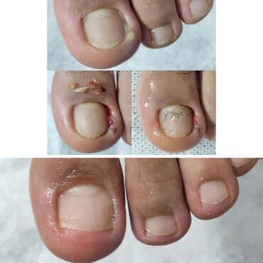 Ичине кирип өскөн тырмактарды оңдоо, Педикюр, Подолог кызматтары, Консультация, Бир жолку сарпталуучу материалдар lalafo.kg да Ичине кирип өскөн тырмактарды оңдоо, Педикюр, Подолог кызматтары, Консультация, Бир жолку сарпталуучу материалдар