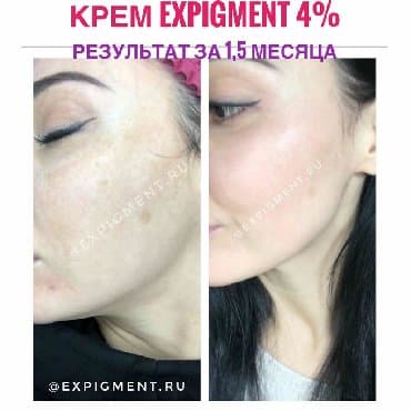 крем для отбеливания кожи и устранения пигментных пятен: Крем Expigment напрямую с Турции. В составе гидрохинон. доставка по — 2