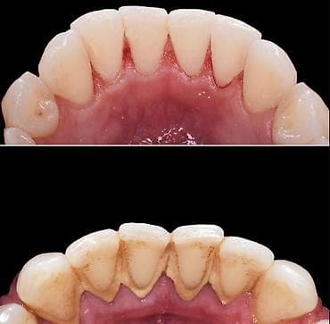 Стоматология Бишкек 📍 Акция на 3 дня Чистка / отбеливание / лечение
