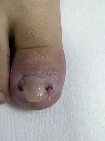 ноктя: Предлагается профессиональная услуга по лечению вросшего ногтя — 2