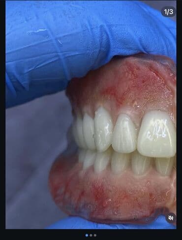 реставрация 4 зуба: Врачи | Стоматолог | Диагностика — 8