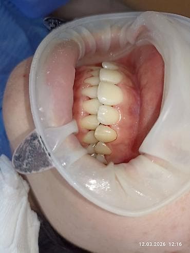 анатомический: Ортодонтическое лечение: установка брекет‑системы на нижнюю челюсть - — 6