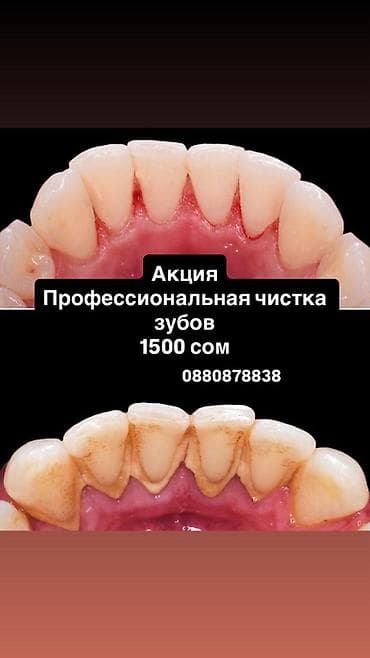 патолок уста: Акция: профессиональная чистка зубов — 1500 сом. Услуга включает: - — 1