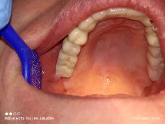 хиджама кровопускание: Клиника | Стоматолог | Протезирование — 6