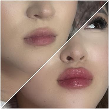 губ: Косметология, Увеличение губ, Консультация, Гипоаллергенные материалы, Сертифицированный косметолог — 4