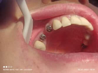 хиджама кровопускание: Клиника | Стоматолог | Протезирование — 3