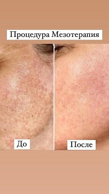 red magic 6: Профессиональные процедуры для кожи лица: лечение акне, постакне и — 5