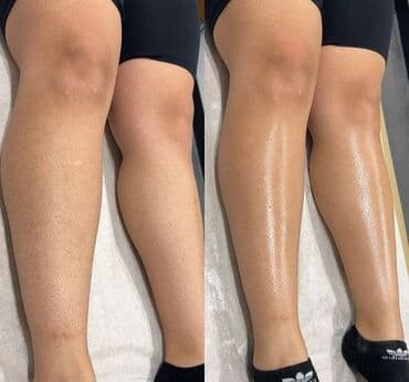 хиджама кровопускание: Акция все тело за 1200 сом.Шугаринг — профессиональная сахарная — 15