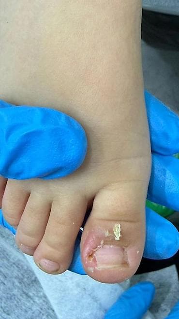 апарат станок: Коррекция вросших ногтей, Педикюр, Одноразовые расходные материалы — 4