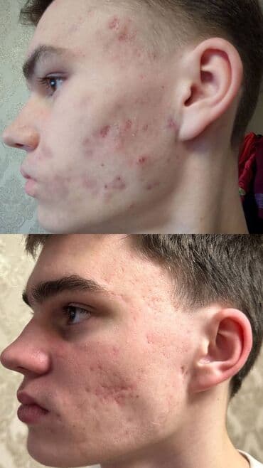 медицинский массаж курсы: Косметология, Демодекоз, Контурное моделирование, Лечение угревой болезни, Консультация, Гипоаллергенные материалы, Сертифицированный косметолог — 19