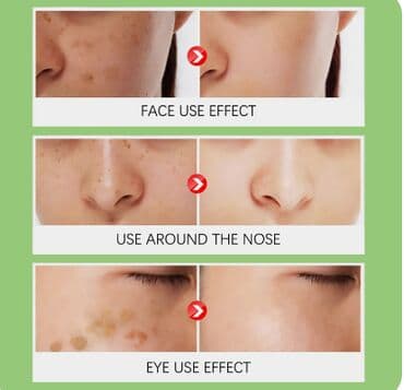 эффективный отбеливающий крем для зоны бикини в аптеке: ❄️ США Крем интенсивное отбеливание с Аmazon и Еbay Крем дает ▶ — 14