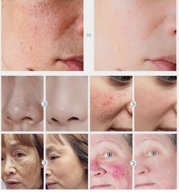 прыщей: ❄️ США СЫВОРОТКА ДЛЯ КОЖИ ОТБЕЛИВАНИЕ цена-450сом\флак-розниц — 8