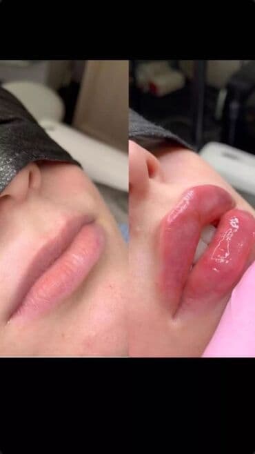 нейлоновые зубные протезы в бишкеке цены: Косметология, Ботокс, Биоревитализация, Ботулинотерапия, Консультация, Гипоаллергенные материалы, Сертифицированный косметолог — 3