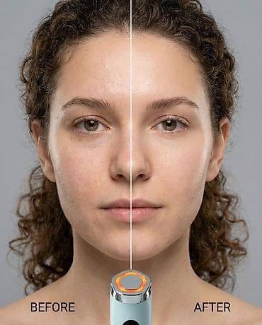 ring light: Аппараты для домашнего лифтинга от mommy care: PentaPrime и V-THERA — 2