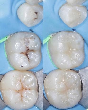 клиника дентомакс бишкек: Лечение кариеса 
Фотопломба
Чистка
Удаление 
Протезирование — 5