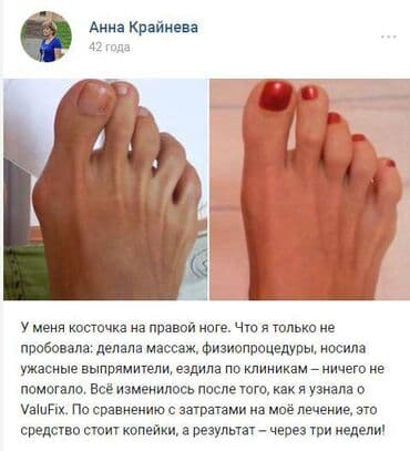 Кислородные подушки: Valufix- hallfix фиксатор от вальгусной деформации +бесплатная — 8