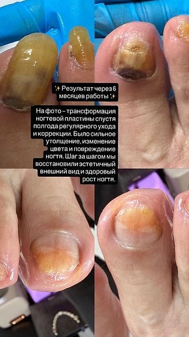 трещина: Коррекция вросших ногтей, Услуги подолога, Одноразовые расходные материалы — 1