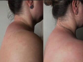 массаж швз: Массаж | Лимфодренажный массаж | Остеохондроз, Протрузия, Кифос, лордоз | С выездом на дом, Консультация — 3