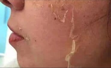 накладные брекеты для красоты купить: Косметология, Пилинг, Чистка кожи, Консультация, Гипоаллергенные материалы, Сертифицированный косметолог — 2