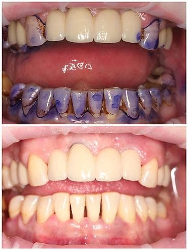 массаж кок жар: Профессиональная гигиена полости рта (ультразвуковая чистка + AirFlow — 1