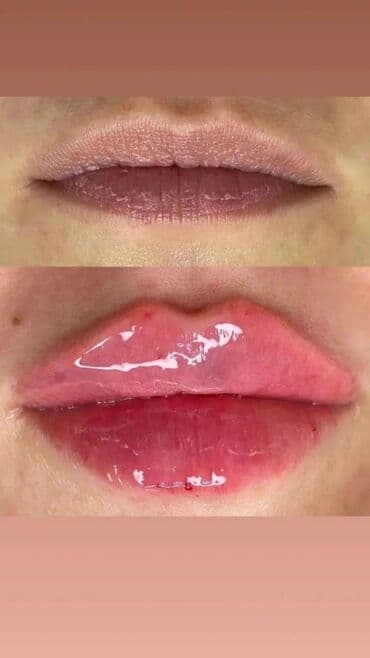 нейлоновые зубные протезы в бишкеке цены: Косметология, Ботокс, Биоревитализация, Ботулинотерапия, Консультация, Гипоаллергенные материалы, Сертифицированный косметолог — 9