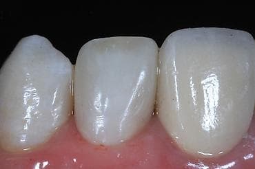 Реставрация передних зубов композитом (эстетическая пломба) - — 4