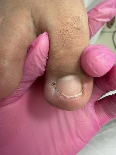 удаление папилом: Коррекция вросших ногтей, Педикюр, Одноразовые расходные материалы — 1