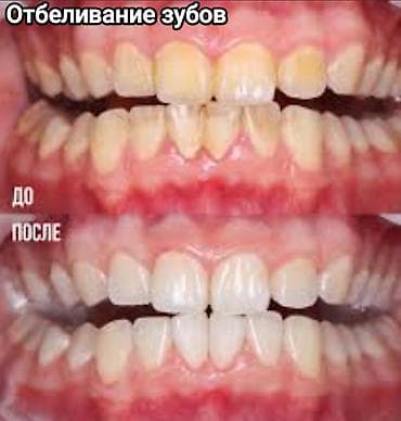 протезы для ног: Съёмные зубные протезы под ваши задачи - Вакуумные протезы: плотная — 9