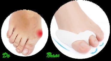 эспандер для челюсти: Фиксаторы большого пальца (от вальгуса) Ночные и дневные Цены от 350 — 3