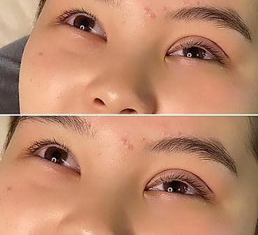 шрам: Жип менен сурма чыгарабыз, операциясыз, кесилбейт, Оорубайт, шрам — 9