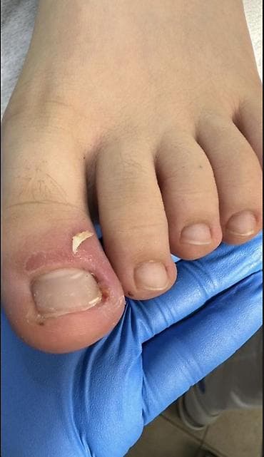 пятка: Коррекция вросших ногтей, Услуги подолога, Консультация — 1