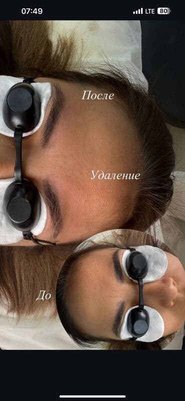 художественная реставрация зубов композитными материалами: Удаление старого перманента бровей — лазером и маслом. - — 2