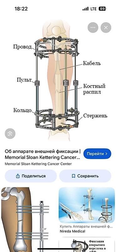 Аппарат внешней фиксации (комплектующие для сборки) Назначение: -