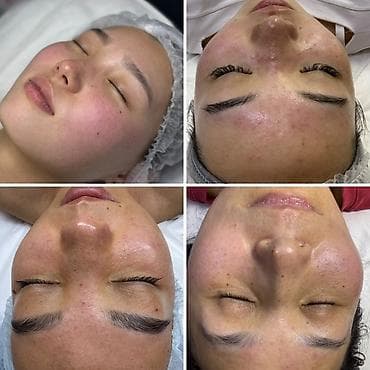 пили: Профессиональная чистка и уход за кожей лица - Глубокая чистка пор — 1