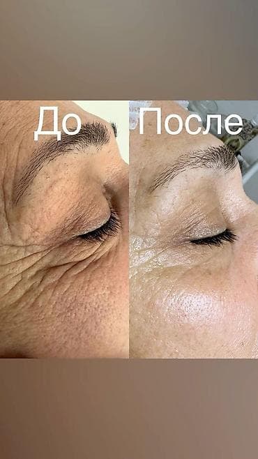 ботекс лица: Косметология, Ботулинотерапия, Сертифицированный косметолог — 5