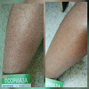 мазь: Здравствуйте! Найден эффективный способ от Псориаза. Я сам болею этой — 10