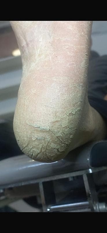 куплю медь: Подологические услуги: лечение и коррекция проблем стоп и ногтей — 2