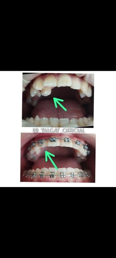 художественная реставрация зубов композитными материалами: Стоматолгиялык кызматтар: Сапаттуу тиш дарылоо — кепилдик менен” “Эми — 5