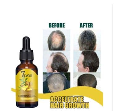 Киреге берилүүчү кийимдер: ❄️ От облысения - имбирь выпадения волос быстрое восстановление — 2