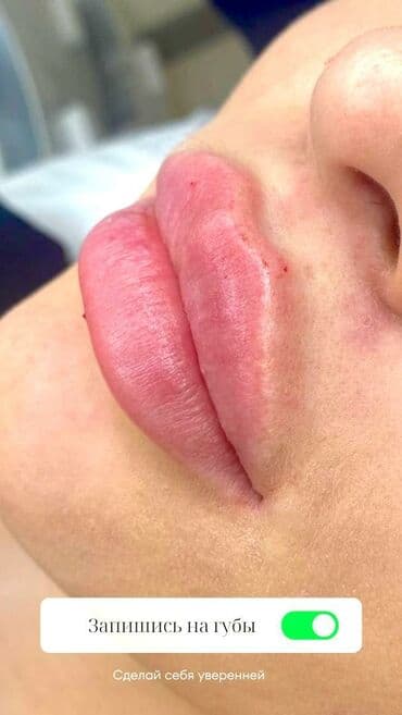 слива ферментированная капсула для похудения отзывы: Косметология, Биоревитализация, Контурное моделирование, Лечение угревой болезни, Сертифицированный косметолог — 8