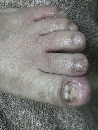 обувь для бокса: Коррекция вросших ногтей, Услуги подолога, Одноразовые расходные материалы — 2